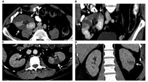 Kidney Infarction In Patients With COVID-19