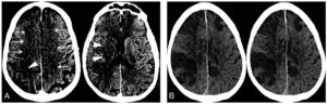 Cerebrovascular Disease In COVID-19