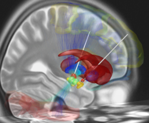 Deep Brain Stimulation For Parkinson’s.