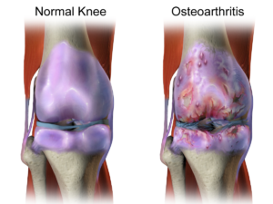 Plant-Based Diet Alleviates The Symptoms Of Osteoarthritis.