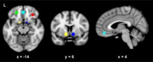 Topiramate Neural Responses And Alcohol Disorder