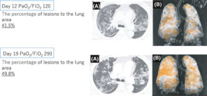 Dual-Energy Computed Tomography COVID Predictive