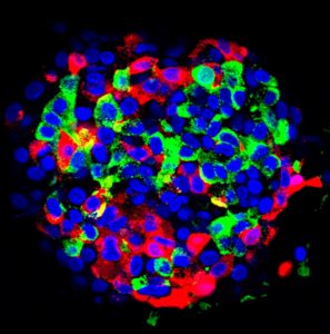 Implant Device Therapy For Type 1 Diabetes – Eileen