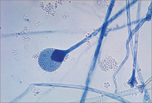 Mucormycosis In Patients With COVID