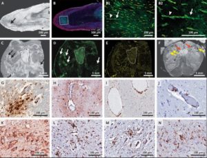 COVID Brain Microvascular Injury