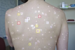 AI Detects Melanoma Skin Cancer