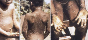 MONKEYPOX OUTBREAK 27 STATES