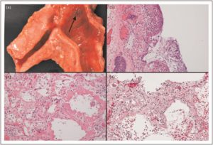 Pulmonary Pathology Of COVID