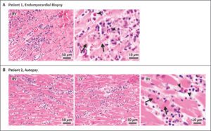 Myocarditis After COVID Vax