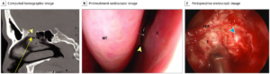 Injury After Nasal Swab Testing For COVID