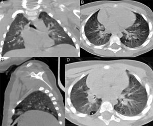 COVID Multiple Pneumatoceles & Diffuse Opacities