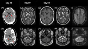 Parkinsonism As A Sequela Of COVID Infection