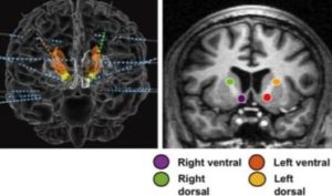 Brain Stimulation For Cognitive Control
