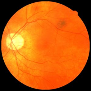 AI Predicts Heart Attack Risk From Retinal Scans