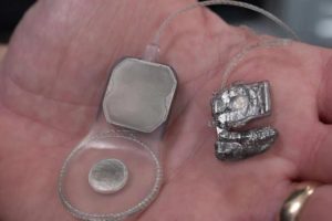 Bionic Eye Is Safe And Stable For Long-Term Implantation