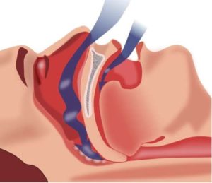 Sleep Apnea Treatment May Not Benefit Patients Older Than 80