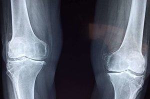 Harnessing Vaccine Technology To Heal Bone