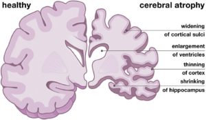 Alcohol Shrinks The Brain