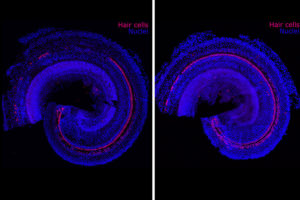 Reversing Hearing Loss With Regenerative Therapy