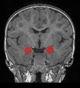 Overgrowth Of Key Brain Structure In Babies Who Later Develop Autism