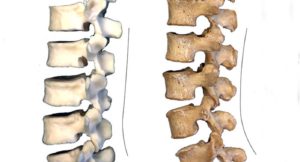 Lower Back Pain & Spondylolisthesis From Neanderthals