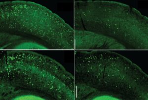 Signaling Pathway In Immune Cells Could Be New Alzheimer’s Target