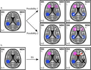 Woman With No Left Temporal Lobe Developed A Language Network In The Right Side