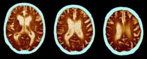 Covid And Concurrent Brain Decline.