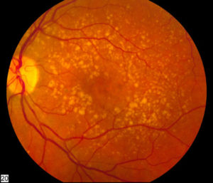 Drug Treatment For Cataracts Moves A Step Closer