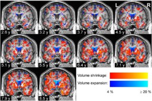 Brain Regions Change In Parkinson’s Disease