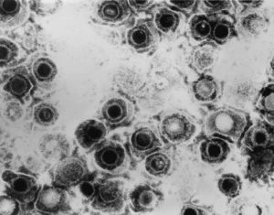 Herpesvirus Infection May Increase Risk Of Developing Diabetes