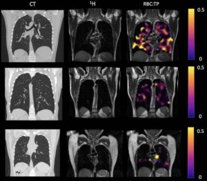 Lung Abnormalities In Non-Hospitalized Long Covid Patients