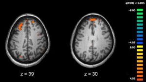 DNA Repeats Reveals Genetic Link To Schizophrenia