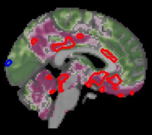 Type 2 Diabetes Accelerates Cognitive Decline