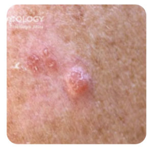 Protect Yourself Against These Deadly Skin Cancers Everywhere On You