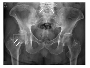 AI Diagnostic Performance For Fractures On Radiographs.