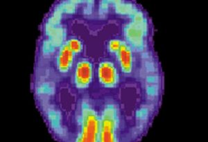 Single Brain Scan Can Diagnose Alzheimer’s Disease