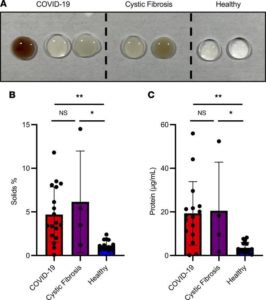 Scientists Decipher The Danger Of Gummy Phlegm In Severe Covid