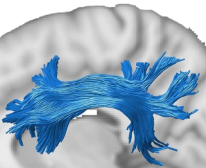 GPUs Discover Human Brain Connectivity