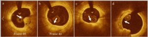 AI-Based Image Analysis Detects Serious Heart Condition