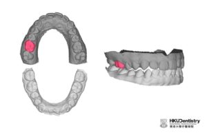 AI-Designed Single Molar Dental Prostheses