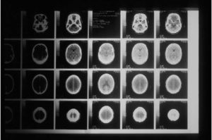 AI Diagnoses Mild Cognitive Impairment That Progresses To Alzheimer’s