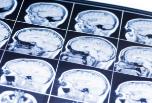 Head Injuries In Children Linked To Reduced Brain Size