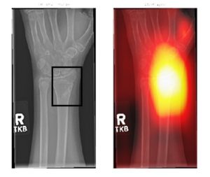 Some Radiographers “Unsure” Of AI Interpreting  X-Rays