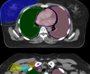 AI Could Save Radiation Therapists And Radiation Oncologists