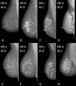 AI’s Accurate Breast Density Classifications