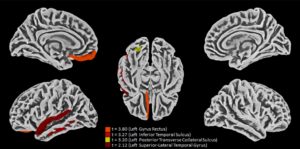 Covid Infecting Astrocyte Cells In The Brain