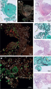 Mechanism Behind Deadly Fungal Infection With Influenza