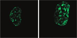 Treatment Of Premature Aging Disease