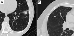 AI Predicts Cancer Risk Of Lung Nodules